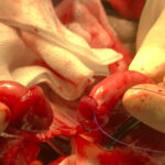 Intestinal Suturing